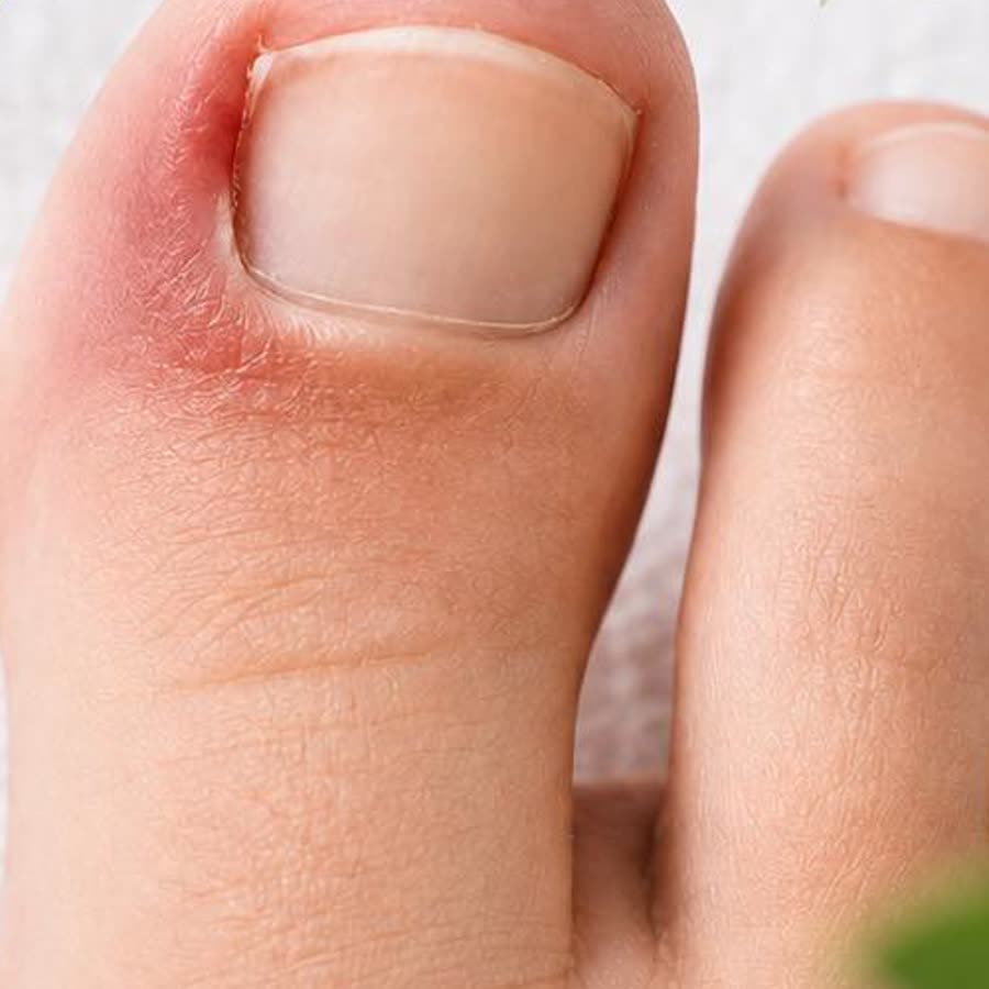 Teen met een rode, ontstoken ingegroeide nagelrand