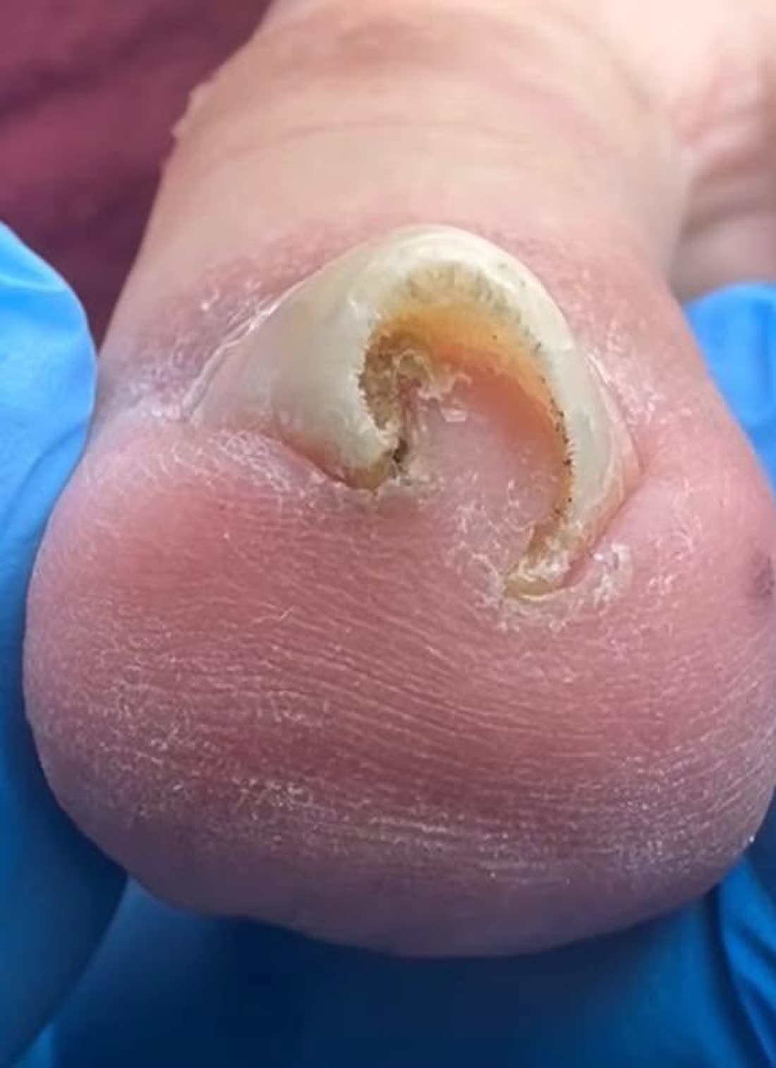 Sterk gekromde teennagel die in de nagelwal groeit