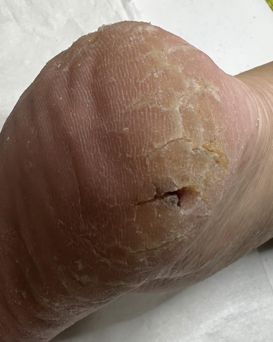 Diepe kloven in een droge, verhoornde hielrand