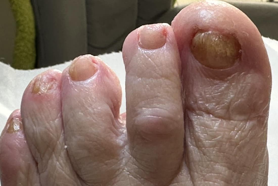 Verdikte, verkleurde teennagels met duidelijke ribbelstructuur