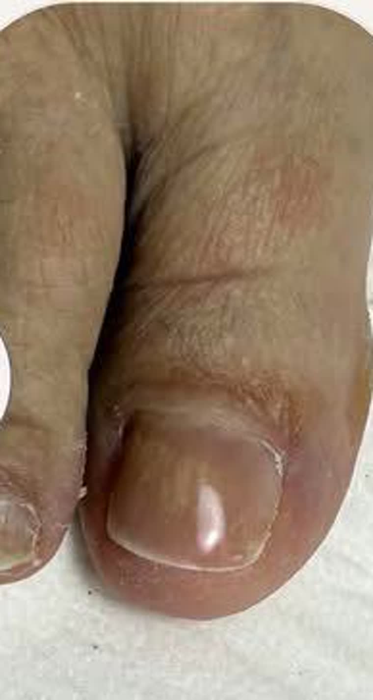 Dezelfde teen na behandeling en nagelreconstructie: een gladde, natuurlijk ogende nagel